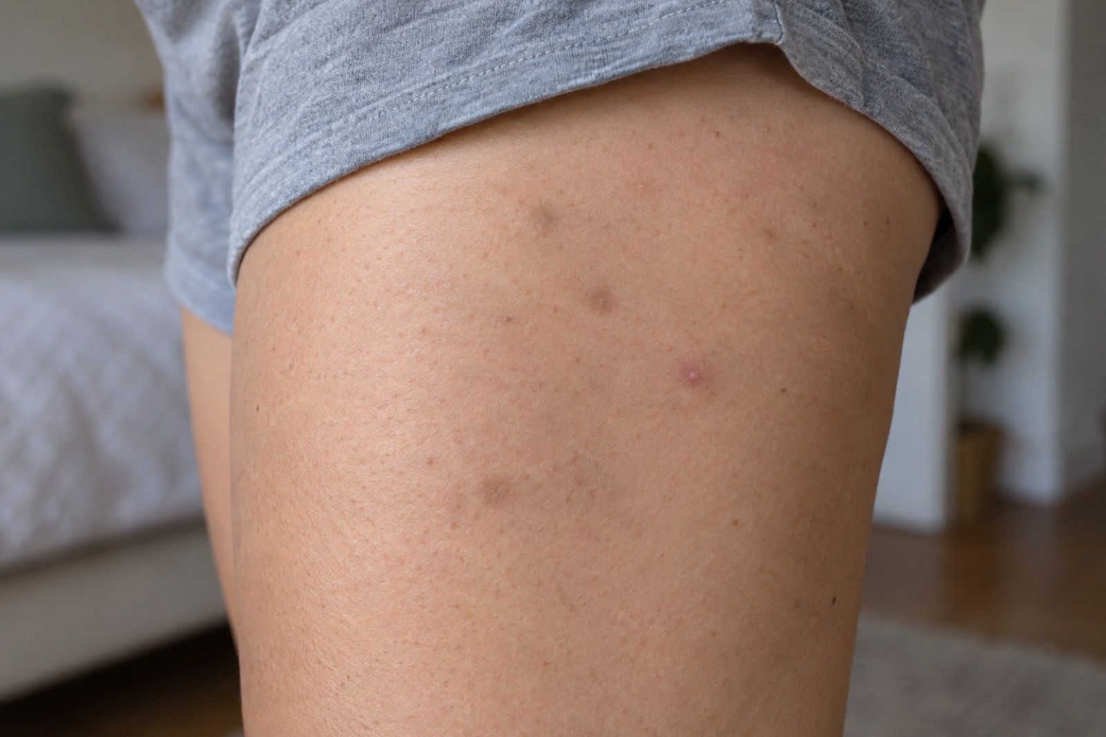 Three or four brown marks and one small pinkish bump scattered on a thigh below the hem of gray shorts