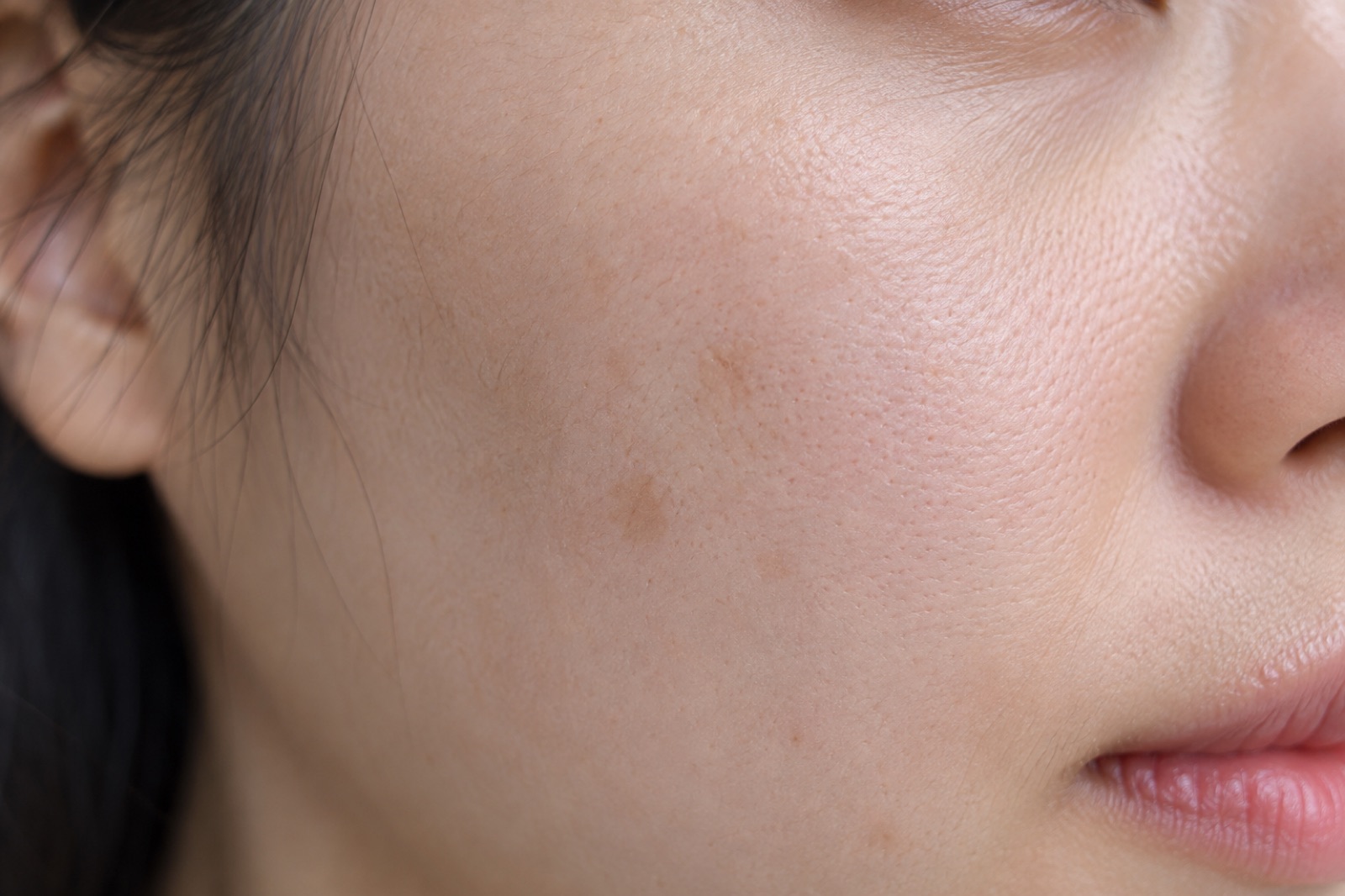 Close-up of a few flat, light brown patches on the cheek between the sideburn and the lips