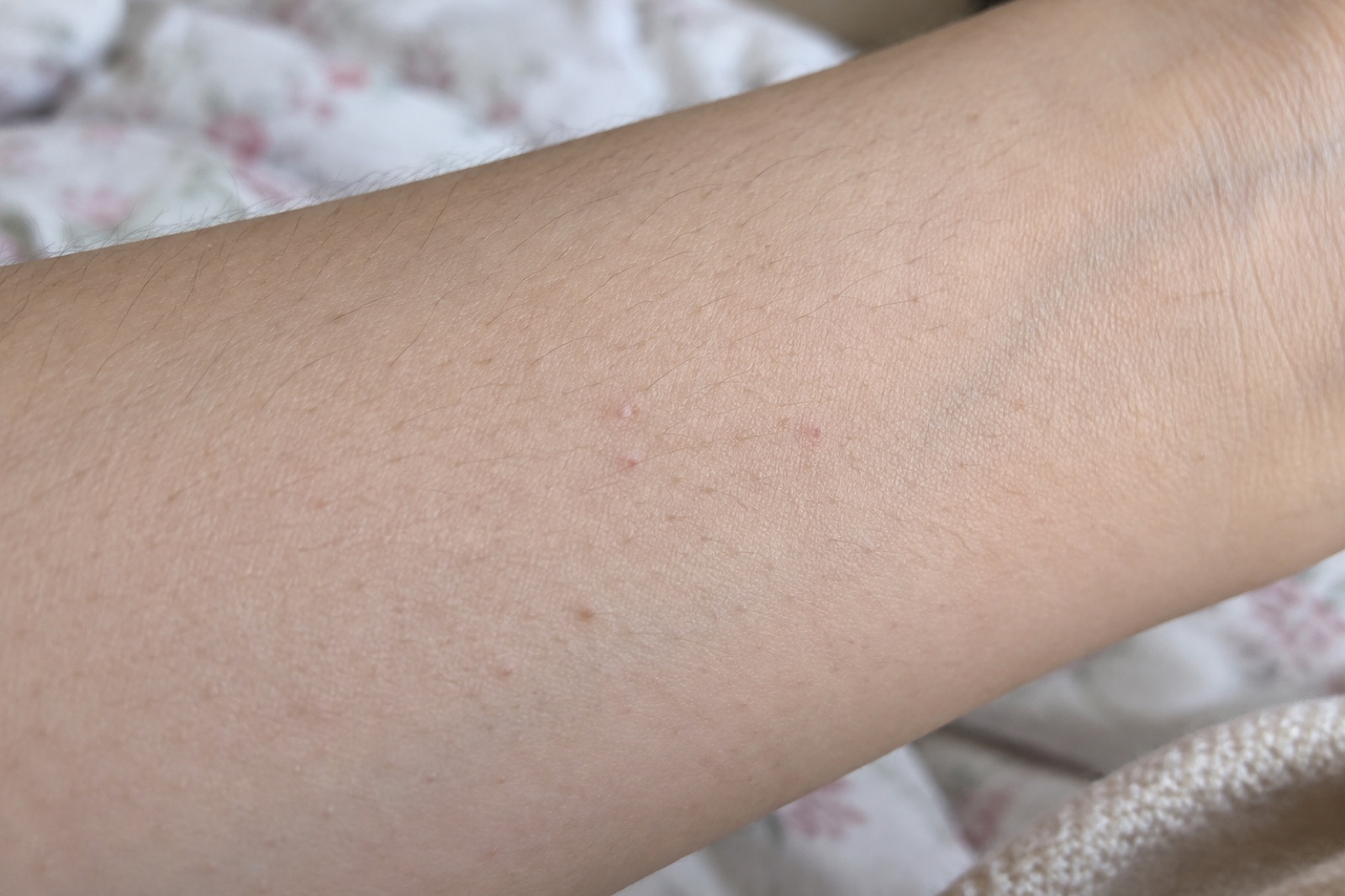 花柄の布団の上にのせた腕の内側。細い毛のあいだに小さなピンクのポツポツが3〜4個見える様子