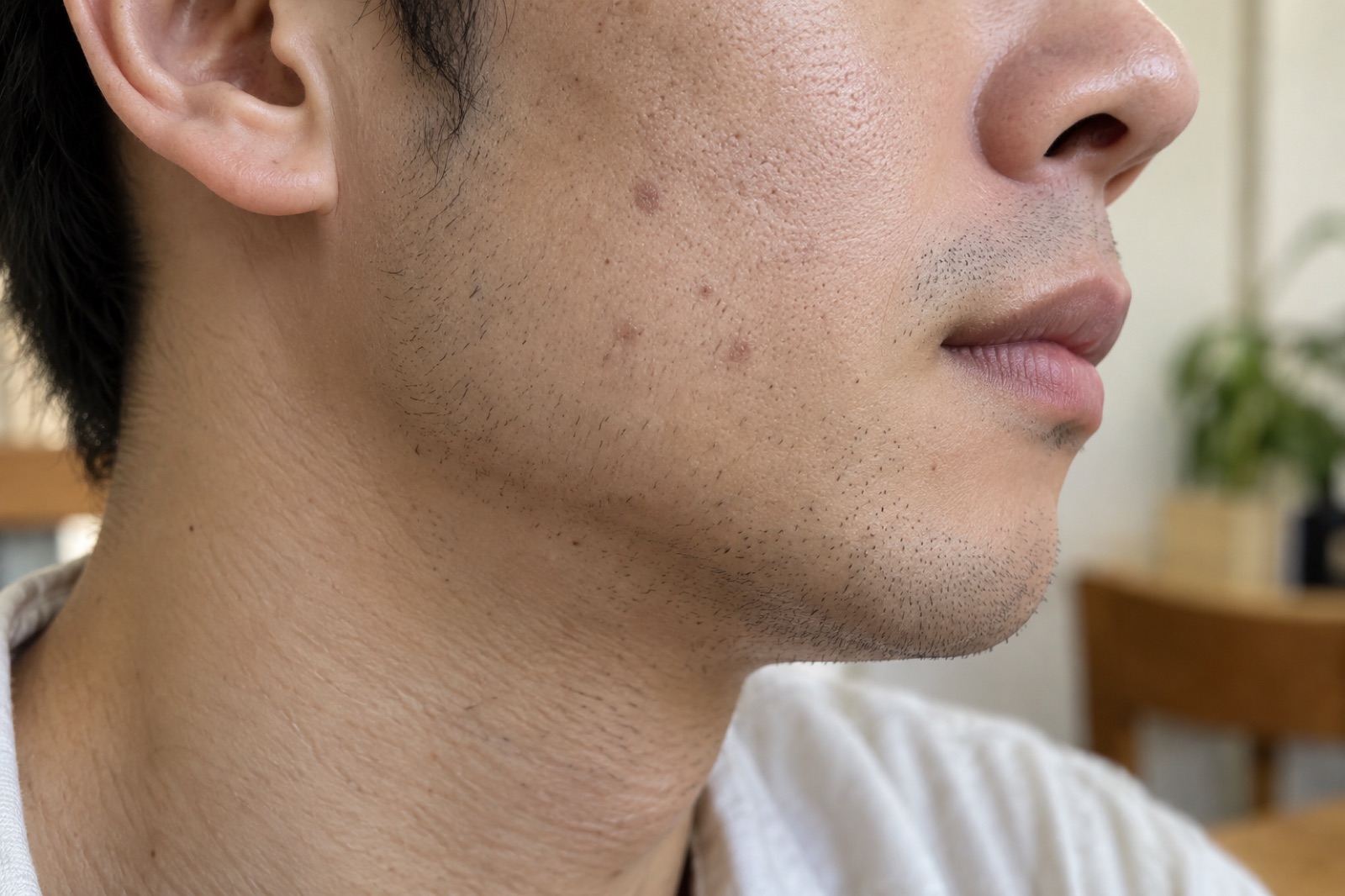 Side close-up of a man with short stubble, with three or four faint brown and pinkish round marks on the cheek below the cheekbone
