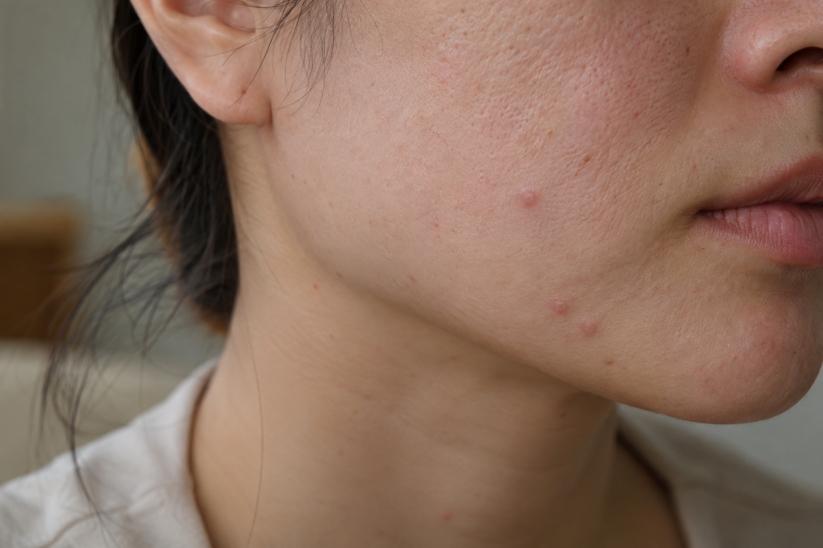 耳の下から口元まで続く女性の横顔のクローズアップ。あごのふちに少し盛り上がったピンク色のブツブツが3〜4個見える